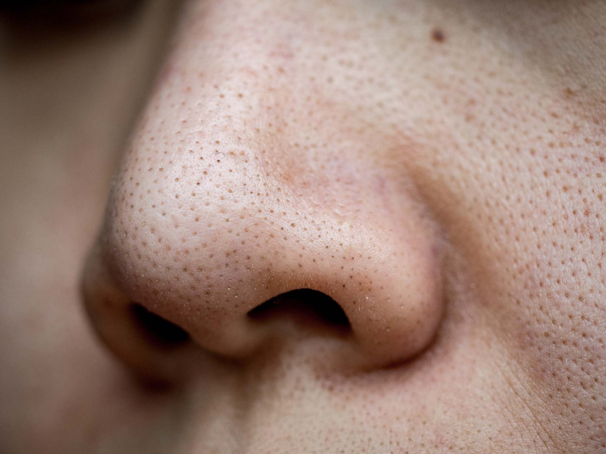 Dark pore openings on a nose
