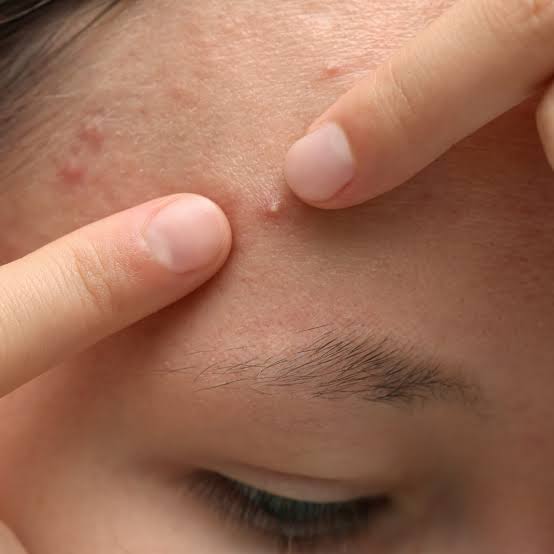 An individual forehead spot with fingers beside it