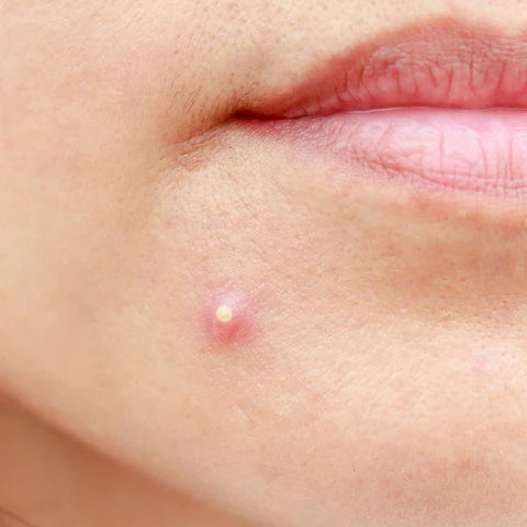 An inflamed pimple with a white centre on a chin