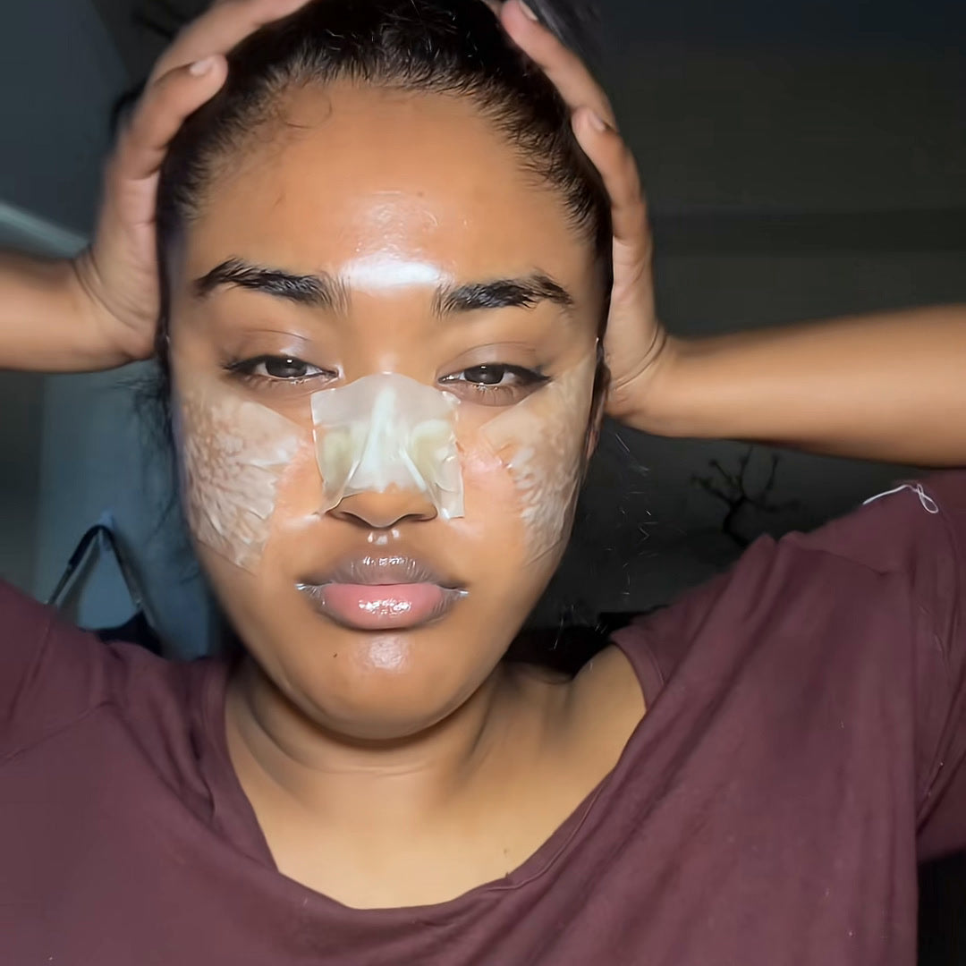 Woman wearing wide hydrocolloid patches across her cheeks and nose