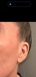 Customer photo: Zero-Fit patch worn on the cheek