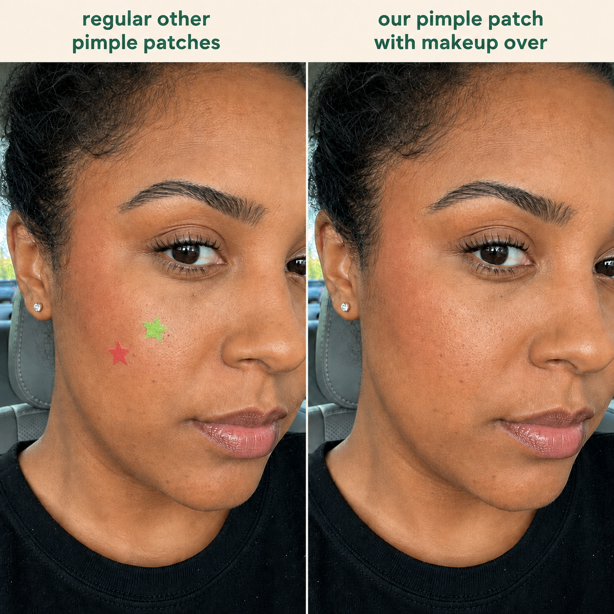Star-shaped pimple patches compared with Zero-Fit worn under makeup