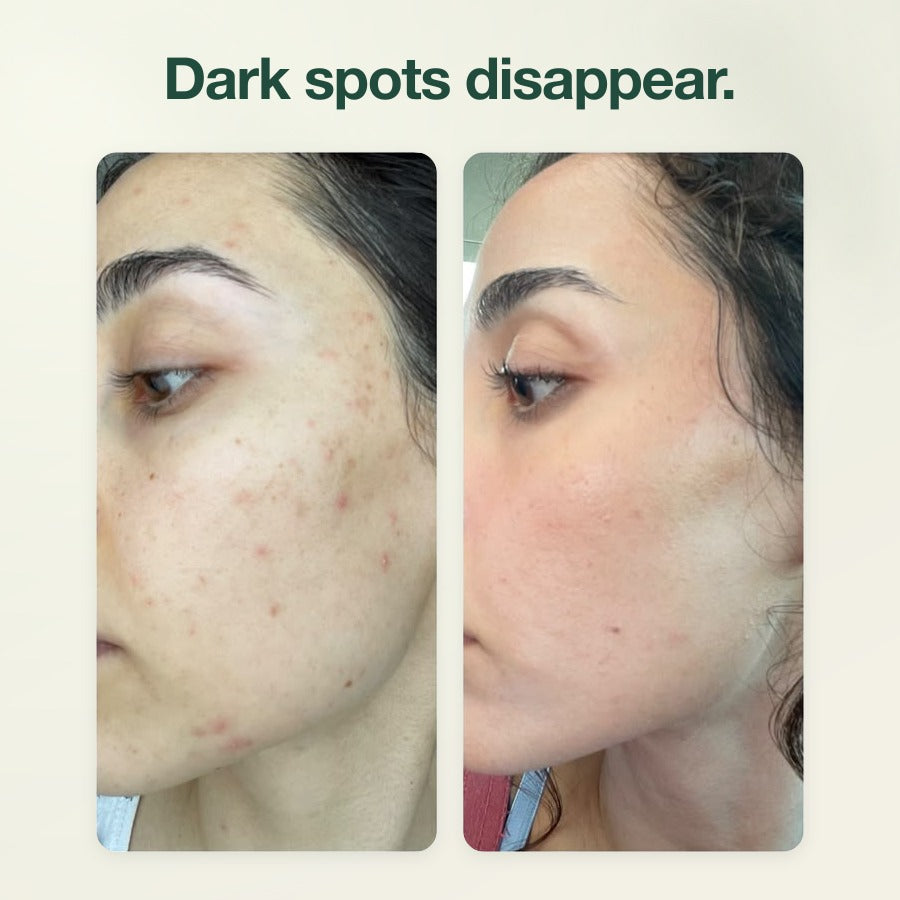 Zero-Fit MELA-C·E dark spot patch before and after: dark spots disappear