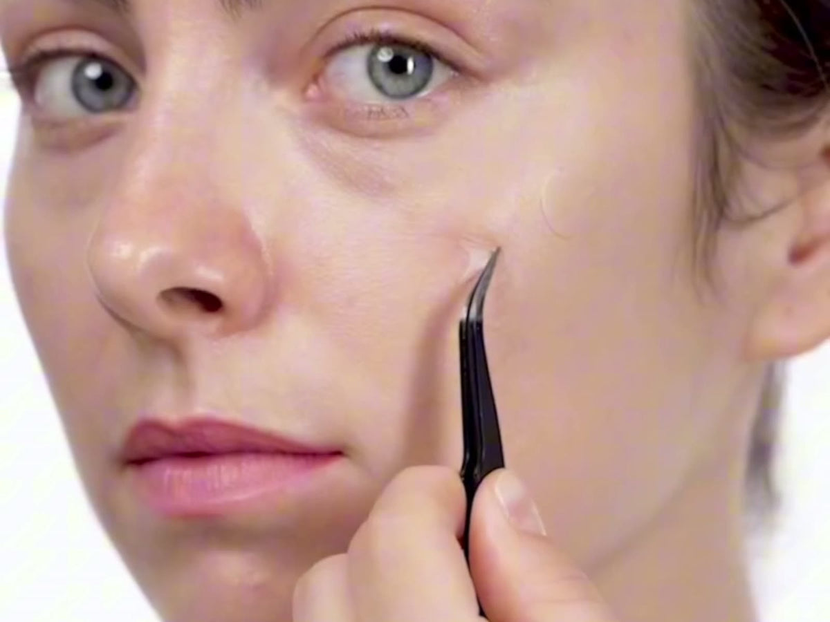 Applying a Zero-Fit patch to the cheek with tweezers.