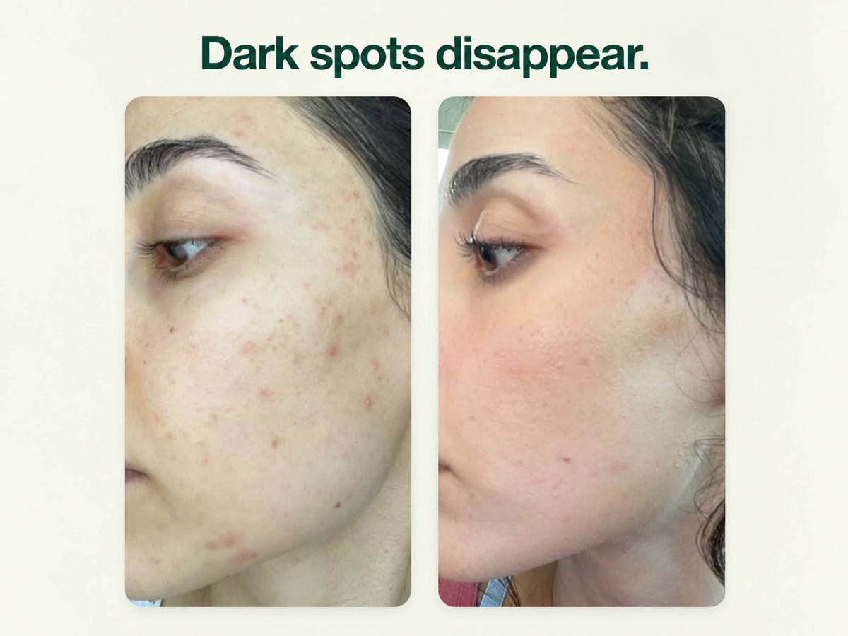 Before and after photographs of a face with post-blemish marks.