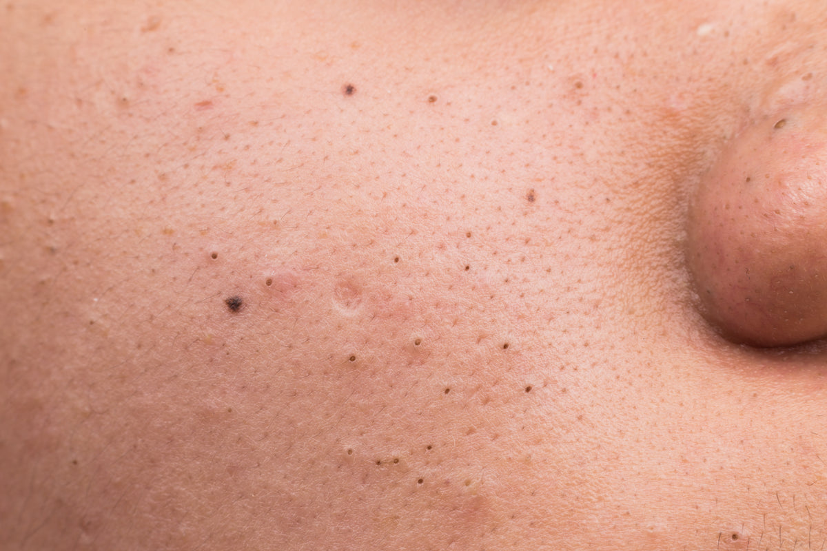 Dark pore openings on a cheek