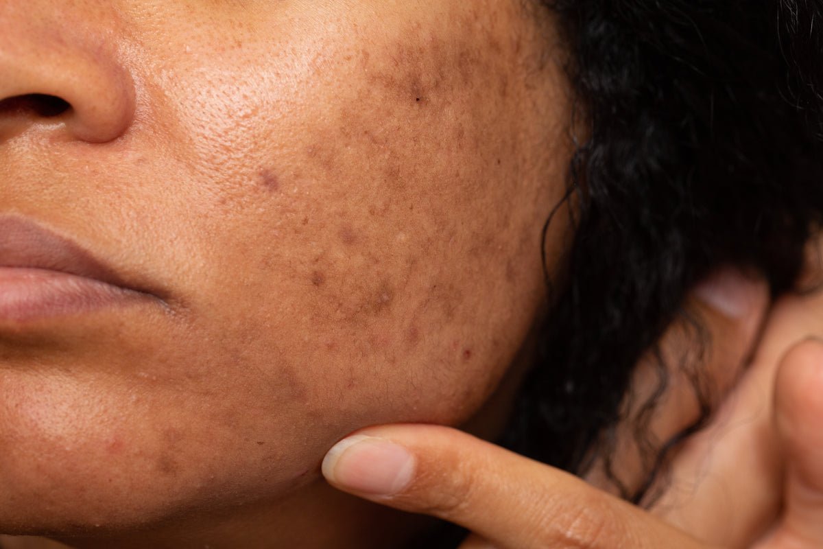 Darker marks on a woman’s cheek