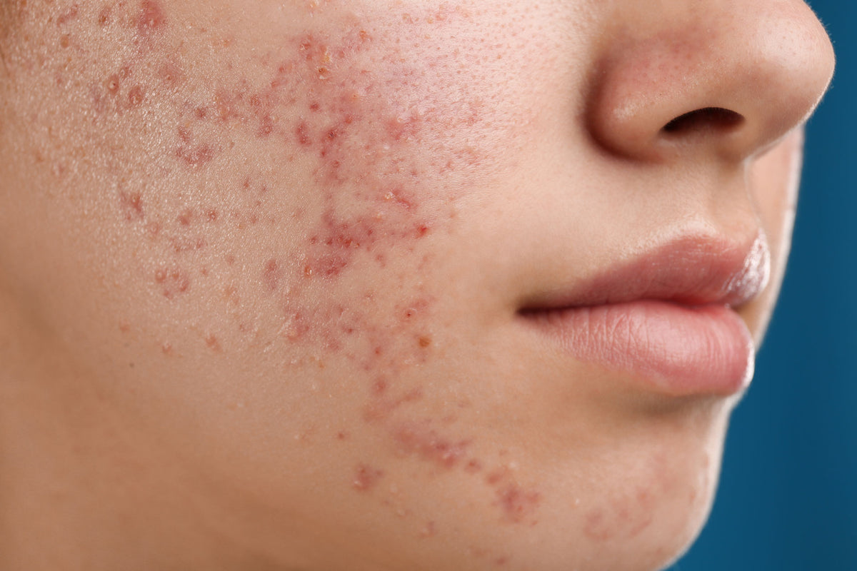 Clustered bumps on a cheek